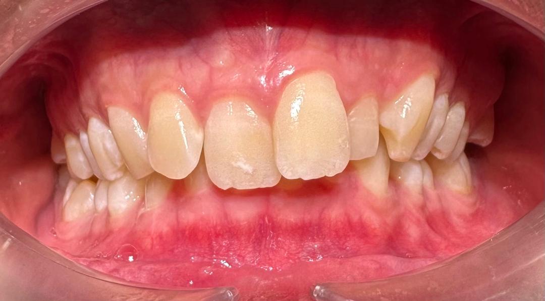 Crowding teeth example