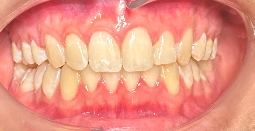 After - Conventional Braces