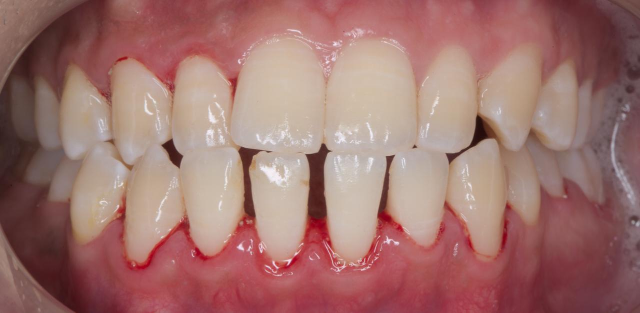 After - Scaling & Polishing